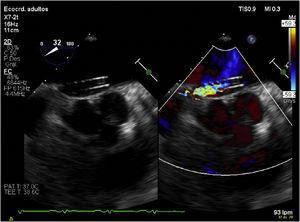 Ecocardiografía transesofágica donde se observa la cánula de infusión transeptal.
