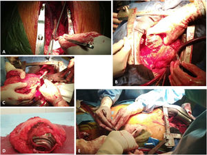 Trasplante con DAVI. A) La imagen muestra la apertura de la membrana de PTFE tras realizar la esternotomía y su apertura siguiendo la trayectoria del injerto de salida. B) La imagen muestra la liberación de la bomba una vez en circulación extracorpórea. C) La imagen muestra la tracción y sección del cable de alimentación una vez realizada la cardiectomía. D) La imagen muestra el corazón extraído con la bomba en ápex de ventrículo izquierdo parcialmente liberada de su cápsula. La figura E muestra la extracción del cable de alimentación por tracción en tramos rectos, una vez revertida la heparina, pero con el tórax aún abierto para permitir revisión de la hemostasia.
