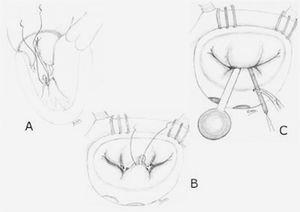 Técnica de medición de la longitud de las cuerdas.