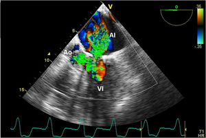 Insuficiencia mitral severa en spray junto con flujo turbulento a nivel del tracto de salida del ventrículo izquierdo por movimiento sistólico mitral. AI: aurícula izquierda; Ao: aorta; VI: ventrículo izquierdo.