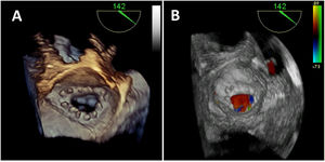 A) Ecocardiografía transesofágica 3D con visión en face de la válvula mitral reparada con anuloplastia. B) Ecocardiografía transesofágica 3D color donde se observa el flujo intraanular normal.