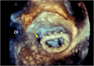 Ecocardiografía transesofágica 3D. Visión en face de válvula mitral reparada con anillo en el que se observa presencia de una fuga perianular en su porción anterolateral (flecha). OI: orejuela izquierda.