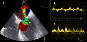 A) Medición de vena contracta (flecha). B) Flujo de venas pulmonares precirugía con predominio de onda diastólica. C) Normalización del flujo de venas pulmonares tras reparación mitral.
