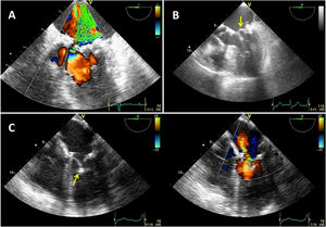 Mecanismos insuficiencia mitral residual tras reparación. A) Tipo I, movimiento normal de velos. IM por perforación, posiblemente por excesiva tracción de velo. B) Tipo II. Movimiento excesivo de velo. Reaparición de prolapso en P2 tras corrección del mismo por suelta de los nudos de neocuerda. C) Tipo III, restricción de movimiento de velo anterior tras neocuerdas insertadas para corregir prolapso.