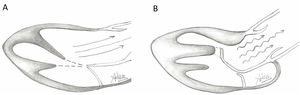 Illustration of normal mitral leaflet coaptation and orientation of papillary muscles axis towards center of mitral valve allowing normal flow through LVOT (A) in contrast to turbulent flow through LVOT caused by abnormal orientation of hypertrophic anterolateral papillary muscle, the presence of a mildly hypertophic sigmoid septum, and secondary ectopic chordae tethering and bending the anterior leaflet of the mitral valve causing a hockey stick deformity.
