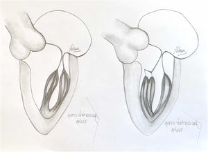 A normal papillary muscle anatomy and coaptation between anterior and posterior leaflet of mitral valve with wide aorto ventricular angle (left) contrasts markedly with an abnormal anteriolateral papillary muscle group with it axis oriented towards the aortic valve instead of mitral valve (right).