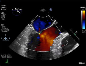 Resting Doppler echocardiogram with no evidence of MR or severe LOVOT obstruction.