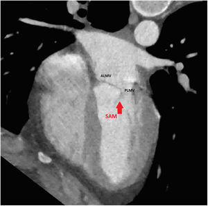Cine CT demonstrating systolic anterior motion of the mitral valve in the setting of a thin septum.