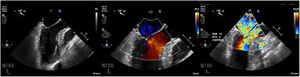 Intraoperative transesophageal echocardiogram showing the presence of systolic anterior motion of the mitral valve (A), Doppler waveform with SAM but no mitral regurgitation (B), and a severe LVOT gradient with mitral regurgitation after the administration of isoproterenol, dobutamine and nitroglycerine (C).