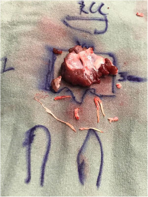 Surgical specimen consisting of resected septal tissue and anomalous chordae.