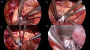 Intraoperative images illustrating thickened ectopic chordae inserting into the base of the anterior leaflet of the mitral valve close to anterior trigon (A), ectopic secondary chordae inserting towards the posterior trigone anterior leaflet of the mitral valve B, evidence of tethering effect of secondary chordae encircled by Prolene thread seen side-to-side with normal A2 segment of the anterior leaflet of the mitral valve being lifted by a nerve hook (C), and papillary muscle realignment using a 4–0 Gore-Tex suture tied over pledgets.