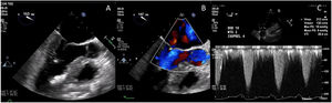 Post-procedural transesophageal echocardiogram demonstrating coaptation of the anterior and posterior leaflets of the mitral valve displaced towards the posterior annulus (A); trace mitral regurgitation during provocation with isoproterenol, dobutamine and nitroglycerine (B); and peak and mean gradients under maximal provocation (C).