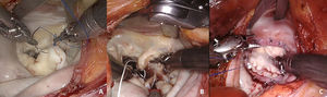 Distintas técnicas de reparación mitral. La figura 1A muestra una resección del velo posterior; la figura 1B muestra el implante de cuerdas de PTFE en el papilar posterior. Finalmente, la figura 1C muestra el resultado final de una anuloplastia con anillo rígido.