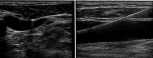 Ecografía de superficie en región cervical para la identificación de vena yugular interna derecha y la introducción de guías para su canulación.