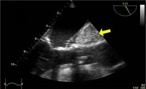 Hematoma aórtico tras la administración de cardioplejia durante CMIV y clampaje aórtico.
