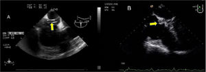 A) Plano medioesofágico bicava modificado cánula de cardioplejia retrograda protruyendo sobre septo interauricular y alcanzando AD. B) Plano cuatro cámaras 0° próximo a diafragma enfocando seno coronario, balón del catéter de cardioplejia retrógrada introduciéndose en el seno coronario.