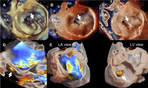 Visualization modes of 3-dimensional full volume of the mitral valve. Legend. Panel A shows the conventional visualization of the 3-dimensional full volume of the mitral valve, resembling the orientation of the surgical inspection, with the aortic valve (Ao) at 12 o’clock and the left atrial appendage (LAA) in the vicinity of the anterior commissure of the mitral valve. In this example, the arrow indicates a redundant, prolapsing central scallop of the posterior mitral leaflet. Photo realistic 3-dimensional rendering of the same image (TrueVue © Philips) is shown in panel B where the chorda rupture can be better visualized (arrow). Panel C shows the cardiac TrueVue Glass © (Philips) which permits another visualization of the mitral valve by peeling away layers and leaving anatomical landmarks. The arrow indicates the chorda rupture and the prolapse of the central scallop of the posterior mitral leaflet. In these two modes of visualization, the observer can place the light to create shadows and enhance the visualization of the structure of interest. In panel D, the 3-dimensional color Doppler flow of the mitral regurgitant jet is shown and visualized with TrueVue Glass to better delineate the origin of the regurgitant jet (arrow). Furthermore, the left atrial and left ventricular side of the mitral valve can be simultaneously visualized helping to understand the origin of the regurgitant jet (arrow) between the central and medial segments of the mitral valve (panel E).