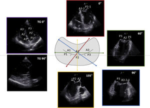 Two-dimensional TEE views for the assessment of mitral valve. Legend. Schematic representation of the MV and the corresponding images from standard TEE views with the respective scallops are displayed.