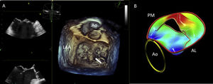 3D TEE imaging with mitral valve parametric mapping. Legend. Panel A illustrates the acquisition of 3D TEE imaging using a zoom mode and the MV visualization from the surgical view in a patient with fibroelastic deficiency. The ruptured chord resulting in P2 flail can be clearly identified (white arrow). Panel B displays the systolic parametric map, obtained using commercial software for MV quantification (4D Auto MVQ, GE Vingmed Horten, Norway). The color on the map indicates the degree of leaflet displacement into the left atrium from the mitral annulus. In this example, the deep-red hue shows the P2 flail with a large coaptation gap. Abbreviations. 3D: three dimensional; Ao: aorta; LAA: left atrial appendage; AL: antero-lateral; PM: postero-medial.