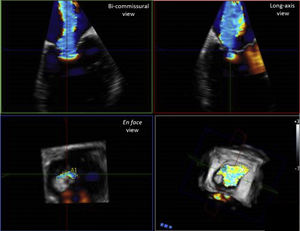 3D echocardiographic technique for the assessment of vena contracta area. Legend. Example of measurement of vena contracta area using 3D commercial software (Q-LAb, Philips Medical Systems, Andover, MA). 3D dataset is manually rotated to parallel the long axis of the jet, in each of the two ortogonal planes. The third plane (en face view from the left ventricle perspective) is set to the narrowest part of the jet, immediately distal to the regurgitant orifice. In this view, vena contracta area can be measured by manual planimetry of the color Doppler signal. In this example of a patient with severe secondary MR, the typical noncircular slit-like vena contracta area along the commisural line is visualized.