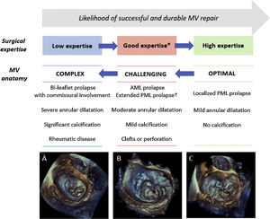 Assessment of the probability of a successful and durable MV repair in primary MR. Legend. The likelihood of performing a successful and durable MV repair is related to the complexity of MV anatomy and the surgical expertise. Decreasing complexity of MV degenerative anatomy are illustrated: (A) bi-leaflet prolapse with A3 flail and annular calcification, (B) large P2-P3 prolapse (involving>50% of the leaflet surface), (C) isolated P3 flail. * Defined as>25 repairs/year per operator or >50 repairs/year per center. † Defined as involving>50% of the PML. Abbreviations. AML: anterior mitral leaflet; PML: posterior mitral leaflet.
