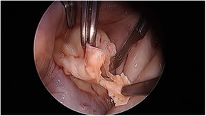 Shaving del velo anterior.