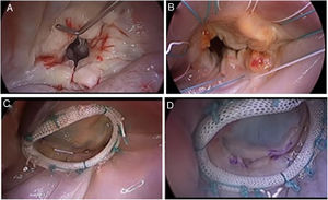 Reparación mitral en insuficiencia de etiología reumática. A) Inspección. B) Puntos de anuloplastia. C) Aplicación de técnicas específicas de reparación en patología reumática e implante de anillo de anuloplastia. D) Resultado final con adecuada superficie de coaptación.