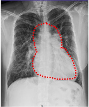 Radiografía AP de tórax demostrando la imagen clásica de «muñeco de nieve».
