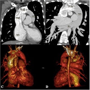 Tomografía computarizada con: A) imagen de reconstrucción multiplanar mostrando conexión de vena vertical a vena innominada; B) imagen de la confluencia de venas pulmonares al colector venoso, con posterior drenaje a la vena vertical; C) reconstrucción tridimensional sagital derecha; y D) reconstrucción tridimensional sagital izquierda mostrando el colector venoso a la izquierda de arco aórtico y que desemboca en la vena innominada y posteriormente a la vena cava superior. AD: aurícula derecha; Co: colector venoso; VCS: vena cava superior; Vin: vena innominada; VV: vena vertical.