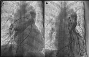 Cateterismo cardiaco que muestra: A) venas pulmonares drenando al colector, vena vertical y vena innominada; y B) venas pulmonares izquierdas drenando al colector.
