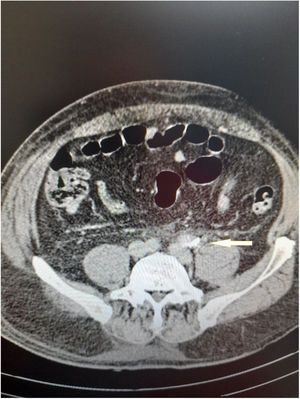 Ubicación del disco que embolizó en arteria ilíaca. Tomografía tomada 11 años después.