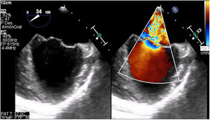 Preoperative echocardiography showing severe mitral regurgitation.