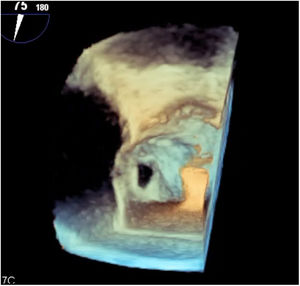 3D echocardiography showing the anterior mitral leaflet perforation.