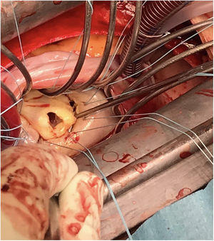 Intraoperative observation of an isolated 7mm leaflet perforation of the A2 segment.