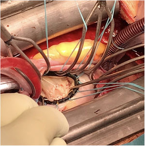 Repair of the mitral perforation with bovine pericardial patch and ring annuloplasty.