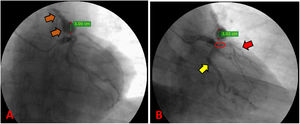 Preoperative coronary angiography. (A) Path of the coronary pulmonary fistula from the LAD to the main pulmonary trunk (orange arrow). (B) Suspected presence of 75% severe coronary artery disease in the proximal LAD (red circle); the path of the LAD (red arrow); the path of the circumflex artery (yellow arrow).