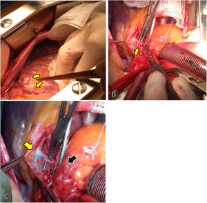 Surgical procedure. (A) Fistula and aneurysmal dilatation in the superior and proximal portion of the left coronary artery. (B) Dissection of the coronary–pulmonary fistula. (C) Fistulous path from the proximal left anterior descending artery (yellow arrow) to the pulmonary trunk (black arrow).