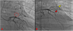 Postoperative coronary angiography. (A) Absence of fistulous tract of the LAD (red circle). (B) Patent IMA-LAD bypass (yellow arrow). LAD without evidence of arteriosclerotic disease in its trajectory (red arrow).