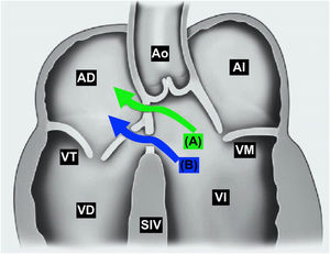 Clasificación del Gerbode. A: Gerbode directo o supravalvular. B: Gerbode indirecto o infravalvular. AD: aurícula derecha; AI: aurícula izquierda; Ao: aorta; SIV: septo interventricular; VD: ventrículo derecho; VI: ventrículo izquierdo; VM: válvula mitral; VT: válvula tricúspide.