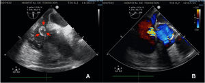 Ecocardiograma transesofágico. Plano apical 90̊ rotado para alinear aurícula derecha y ventrículo izquierdo. (A) Se observa masa en aurícula derecha (flechas rojas). (B) Flujo en el interior de la masa y a través del defecto septal tipo Gerbode.