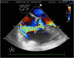 Ecocardiograma transesofágico. Plano de 4 cámaras en el que se observa defecto septal tipo Gerbode supravalvular o directo de gran tamaño y Qp/Qs mayor de 2.