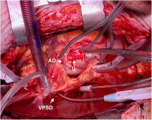 Atriotomía derecha con exposición de la aurícula derecha. Se observa salida auricular del defecto tipo Gerbode. AD: aurícula derecha; G: Gerbode; VPSD: vena pulmonar superior derecha.