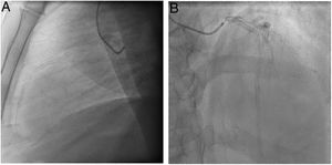 A y B: Cateterismo preoperatorio con múltiples stents(full metal jacket) en la arteria coronaria descendente anterior.