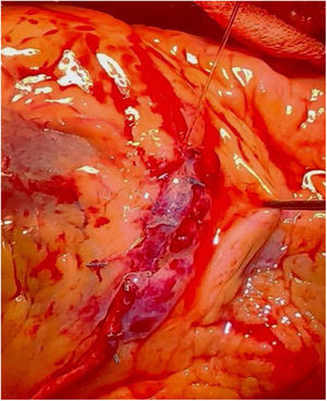Anastomosis distal de la arteria mamaria interna izquierda sobre parche de la vena safena.