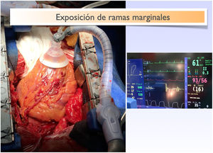 Exposición de ramas marginales empleando sistemas de posicionador cardiaco, consiguiendo una hemodinámica estable.