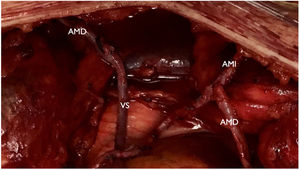 Injerto compuesto con arterias mamarias izquierda (AMI) y derecha (AMD) para revascularizar territorio izquierdo. Vena safena (VS) anastomosada término terminal a muñón proximal de arteria mamaria derecha para revascularizar territorio de la coronaria derecha.