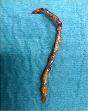 Stentectomía quirúrgica en territorio de la arteria descendente anterior media-distal.