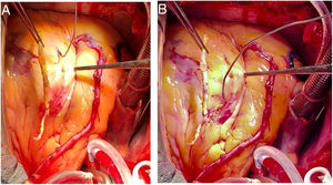 A y B: Endarterectomía coronaria estándar.