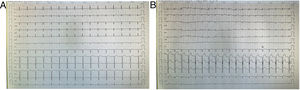 A: ECG preoperatorio que muestra RS a 75lpm, PR 0,16s, eje a 0°, QRS estrecho, con escasa progresión de las R y ondas Q patológicas en V3-V4. B: ECG postoperatorio que mostró RS a 90lpm, con bajo voltaje y supradesnivel del ST de V2-V5.