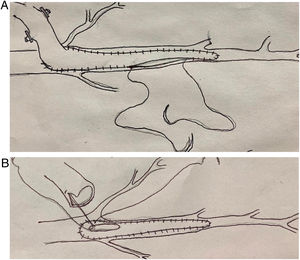 A: Anastomosis amplia de la AMI sobre arteriotomía en la DA, previa extracción de los múltiples stents. B: Parche de vena safena para cierre de arteriotomía amplia usada para extracción de los stents, seguido de anastomosis distal de la AMI.